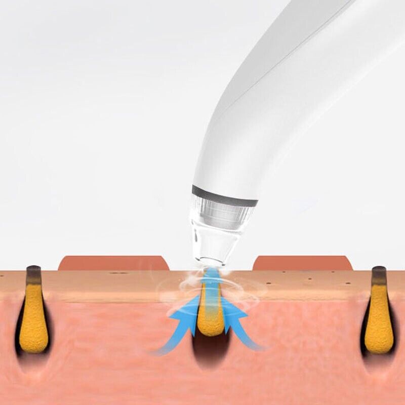 SmartPore™ Blackhead  Remover