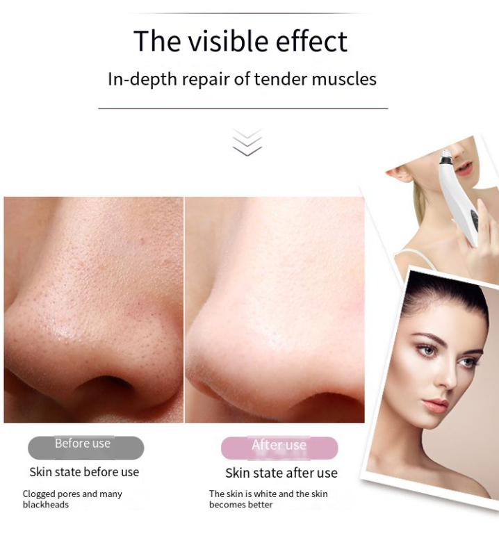 SmartPore™ Blackhead  Remover